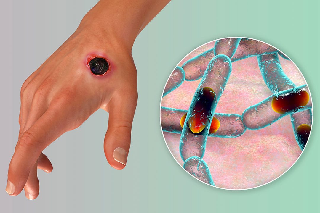 3 persoane infectate cu ANTRAX la Mureș 3 persoane infectate cu ANTRAX la Mureș