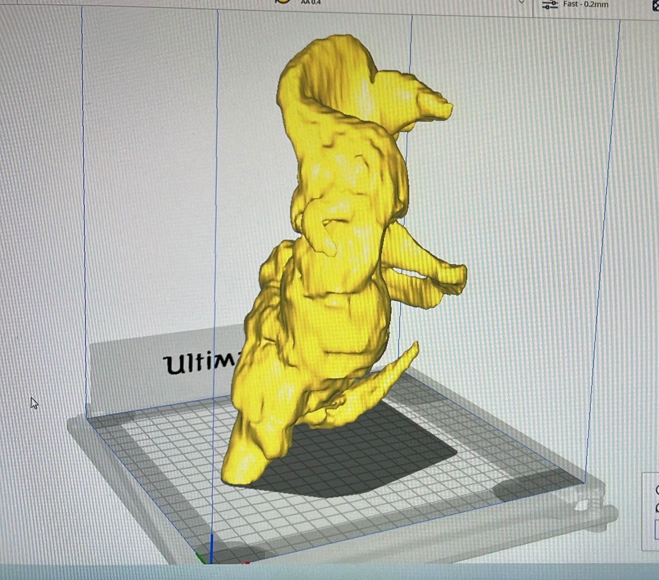 Intervenţie de rezecţie punte osoasă cu machetă 3D preoperator, la Spitalul Clinic Judeţean de Urgenţă Târgu Mureş Intervenţie de rezecţie punte osoasă cu machetă 3D preoperator, la Spitalul Clinic Judeţean de Urgenţă Târgu Mureş