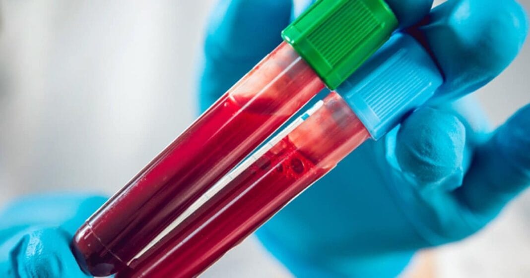 TriOx: Testul de sânge care ar putea revoluționa diagnosticarea cancerului TriOx: Testul de sânge care ar putea revoluționa diagnosticarea cancerului